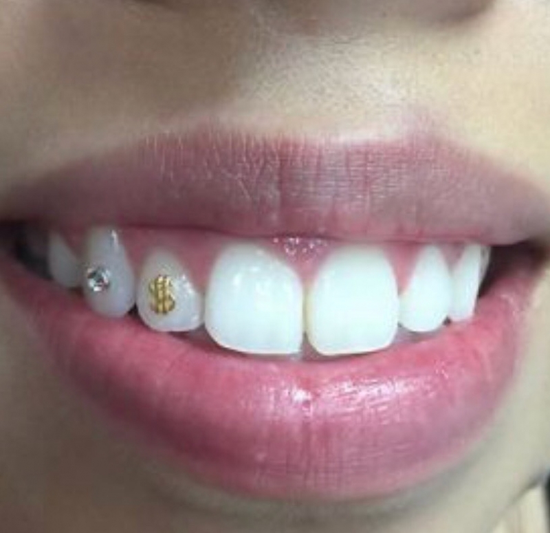 gemstone teeth