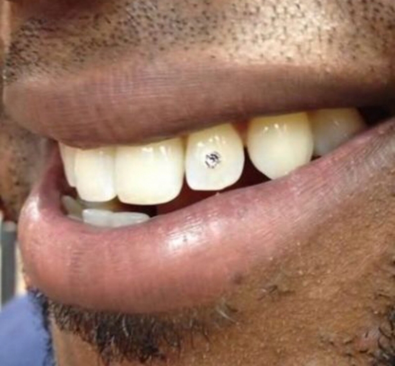 tooth gems