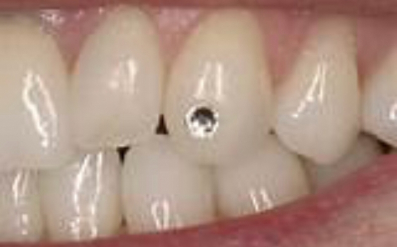 tooth gems price