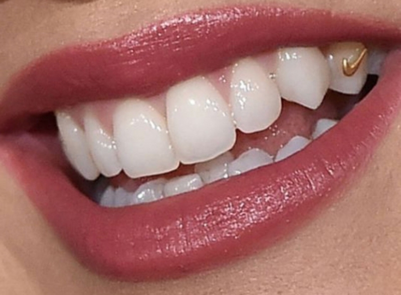 are tooth gems bad for your teeth